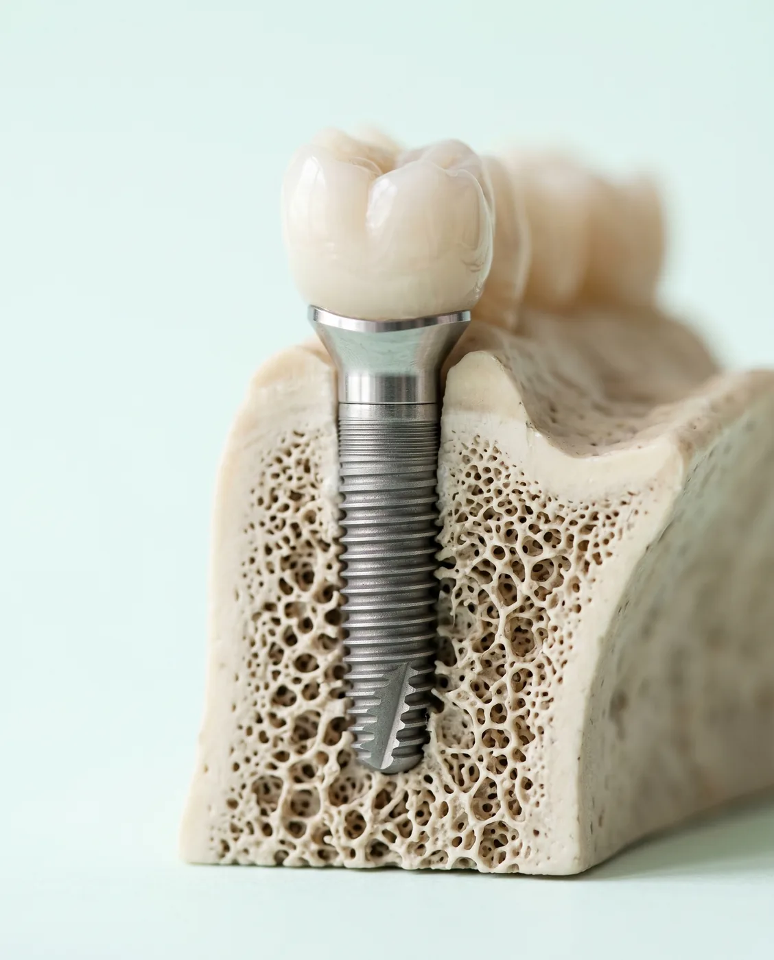 Dental implant cross-section model at Yonge Forest Dental
