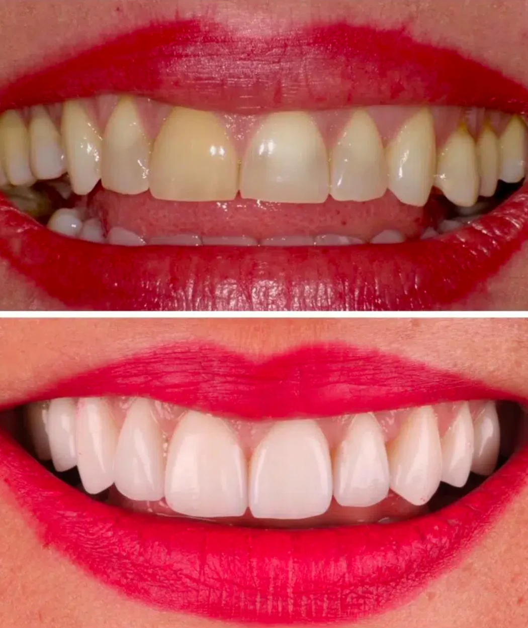 Before and after teeth whitening at Yonge Forest Dental