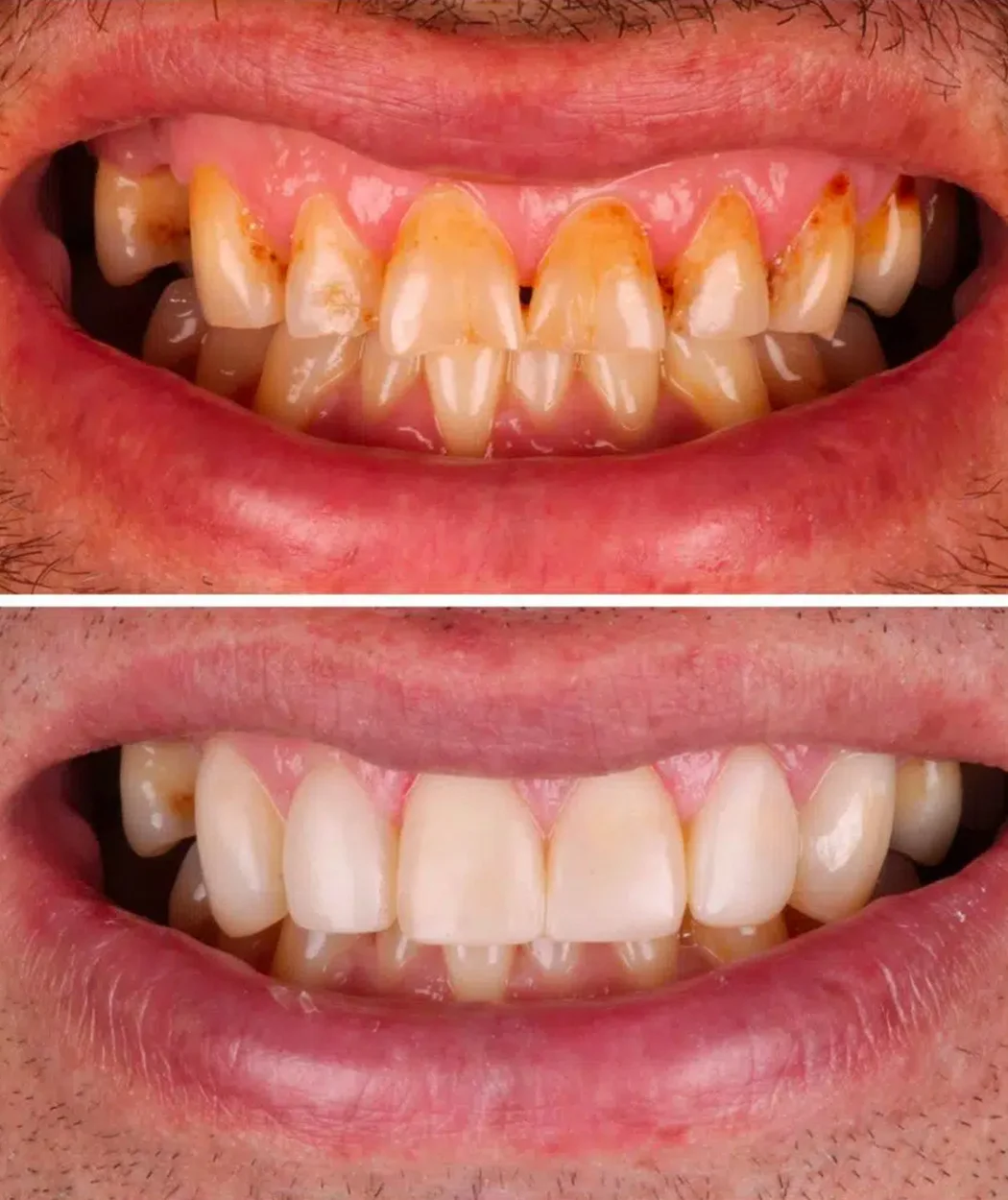Before and after teeth cleaning at Yonge Forest Dental