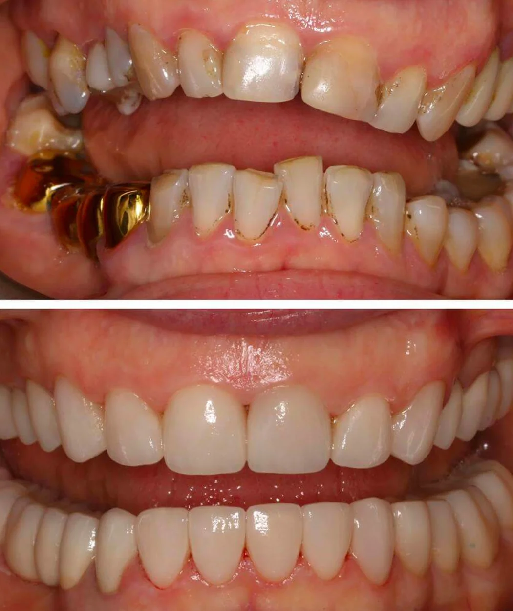 Before and after full-mouth restoration at Yonge Forest Dental
