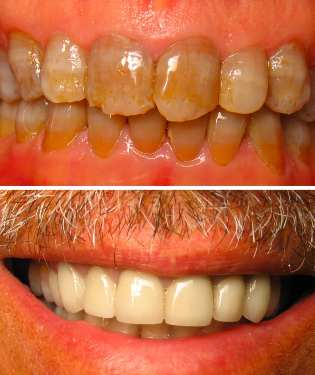 Before and after full-mouth restoration at Yonge Forest Dental