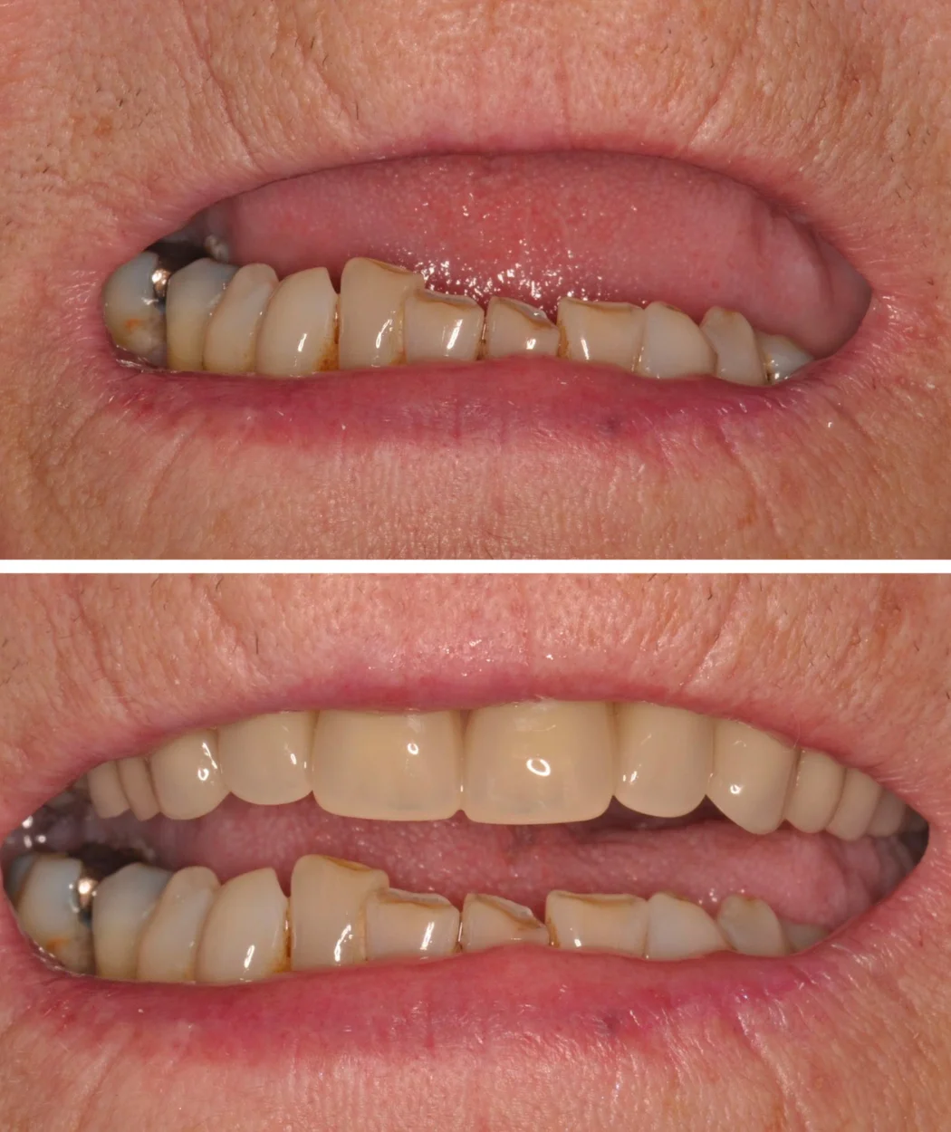 Before and after dental crown at Yonge Forest Dental