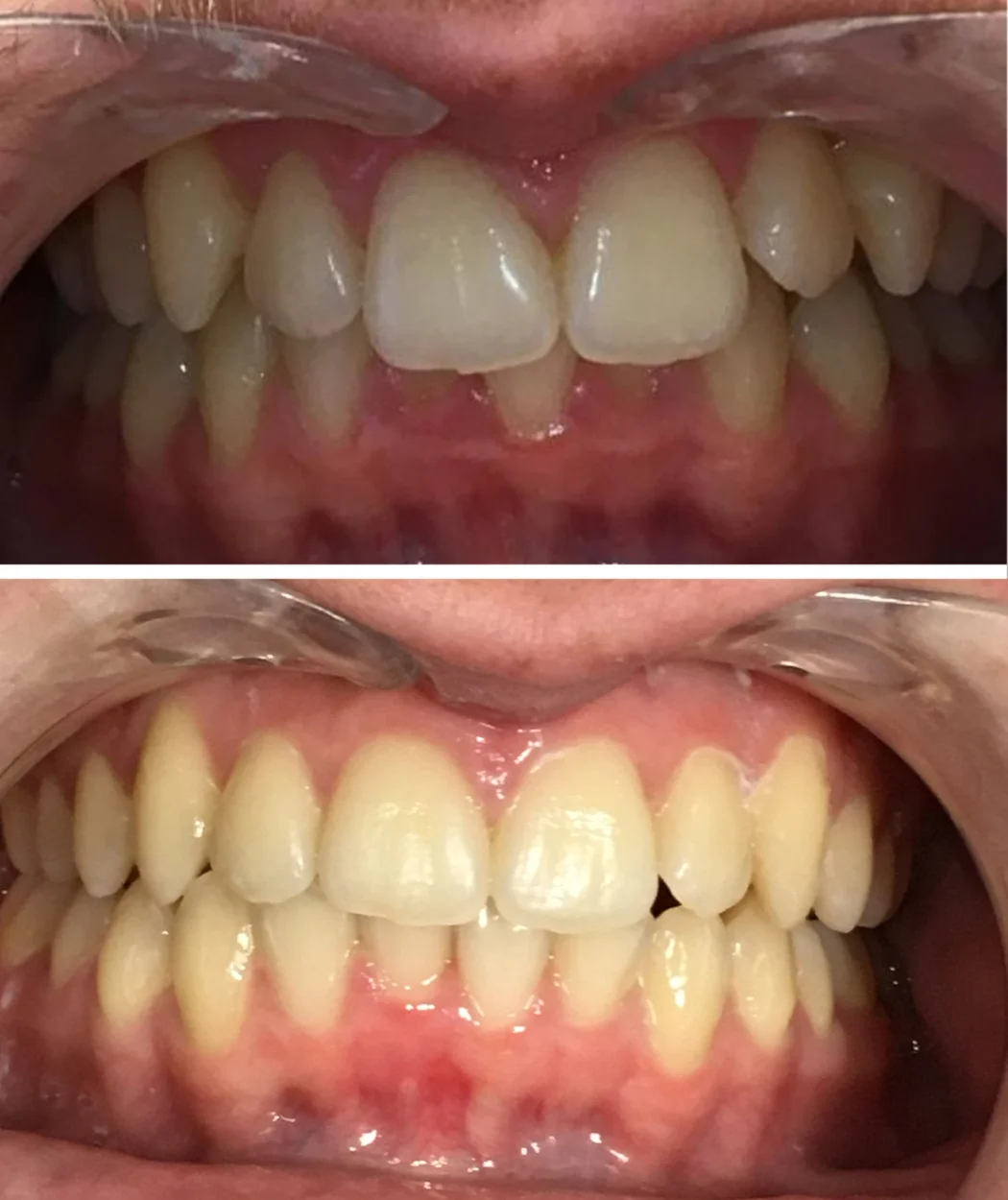 Before and after dental bonding at Yonge Forest Dental