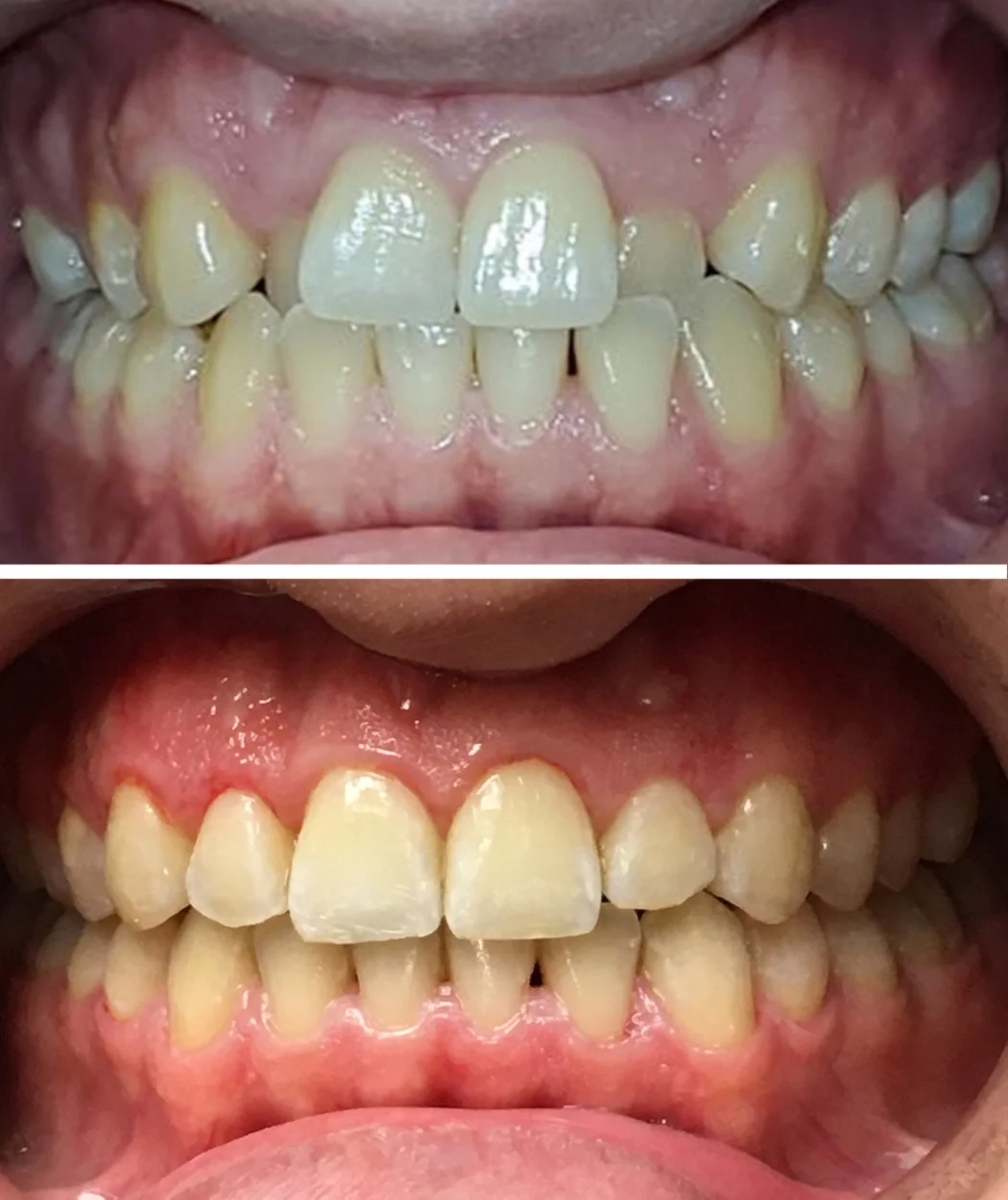 Before and after orthodontic alignment at Yonge Forest Dental