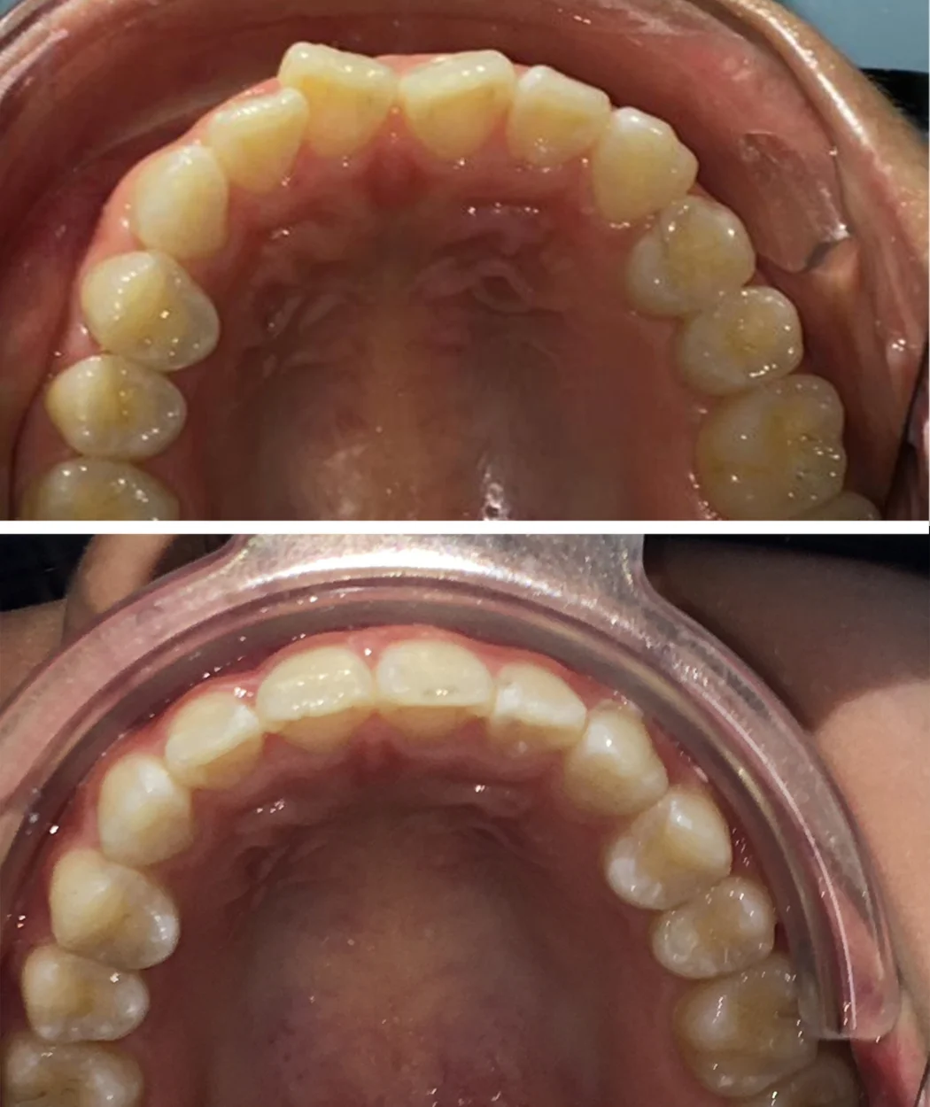 Before and after orthodontic treatment at Yonge Forest Dental