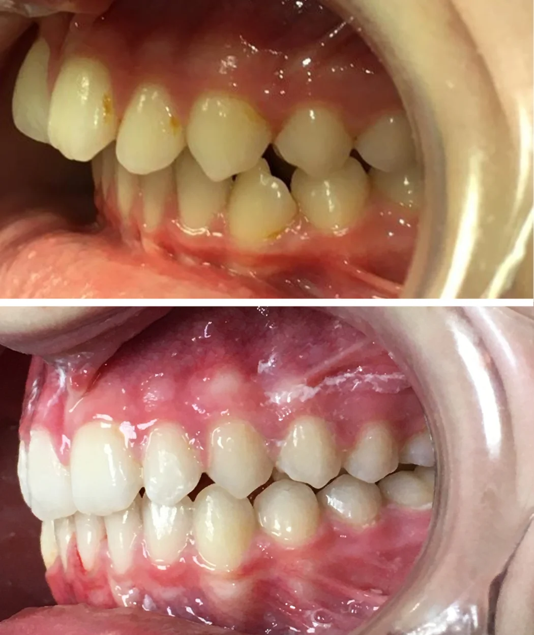 Before and after orthodontic treatment at Yonge Forest Dental
