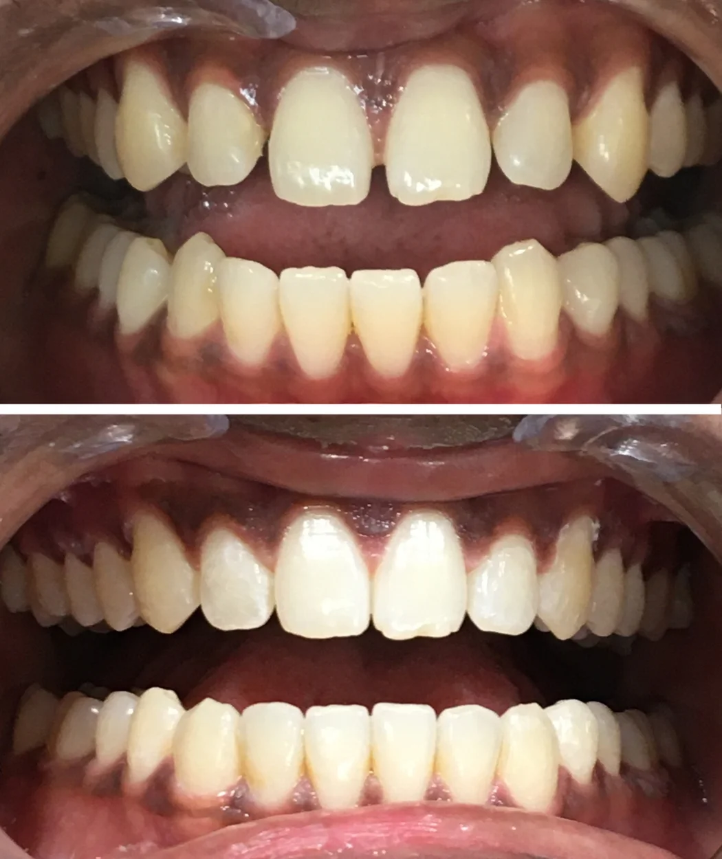 Before and after orthodontic treatment at Yonge Forest Dental