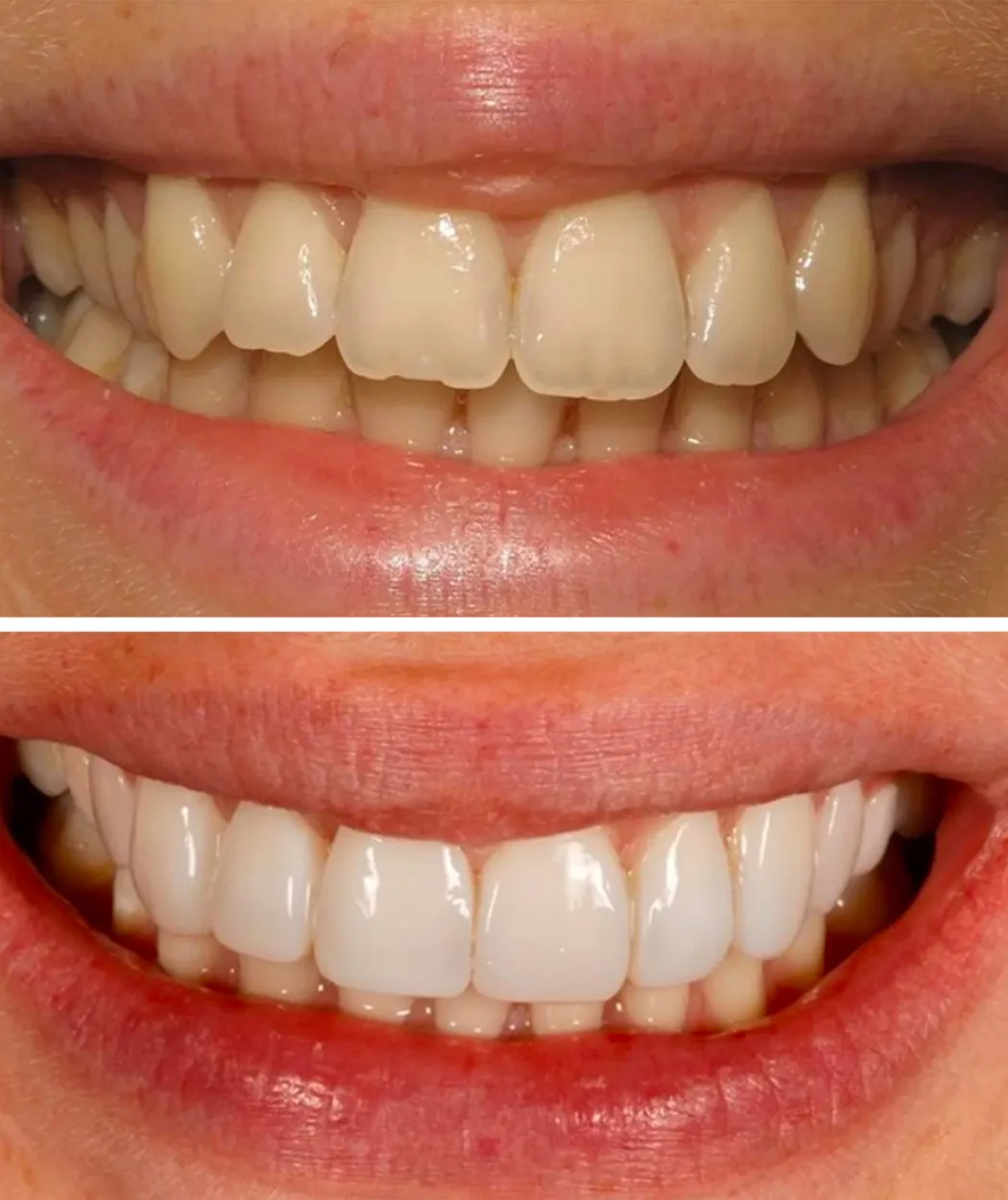 Before and after teeth whitening at Yonge Forest Dental