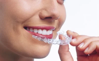 5 Clear Benefits of Choosing Invisalign Over Braces