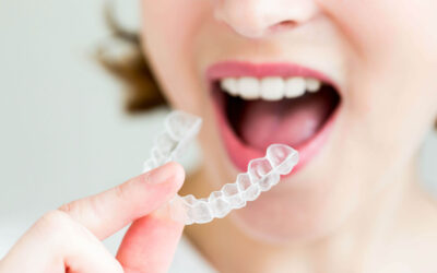 Your Invisalign Journey: Before, During, and After Treatment